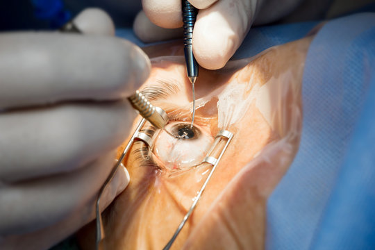  Safeguarding Sight: The Crucial Role of Ophthalmic Instruments in Eye Surgeries